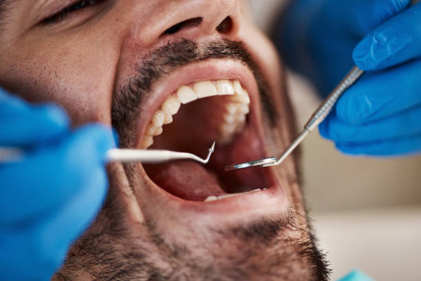 Best Chipped Tooth Repair Near Me  in Harvest, AL